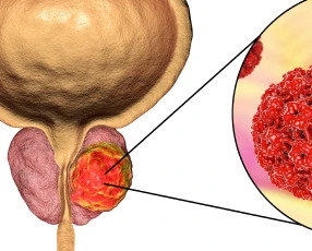 Cancer de la prostate au Cabinet d’urologie à Strasbourg