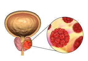 Biopsie échoguidée de la prostate