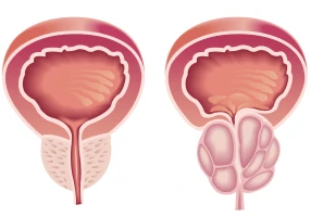 Chirurgie de l’hypertrophie de prostate laser