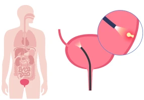 Résection endoscopique