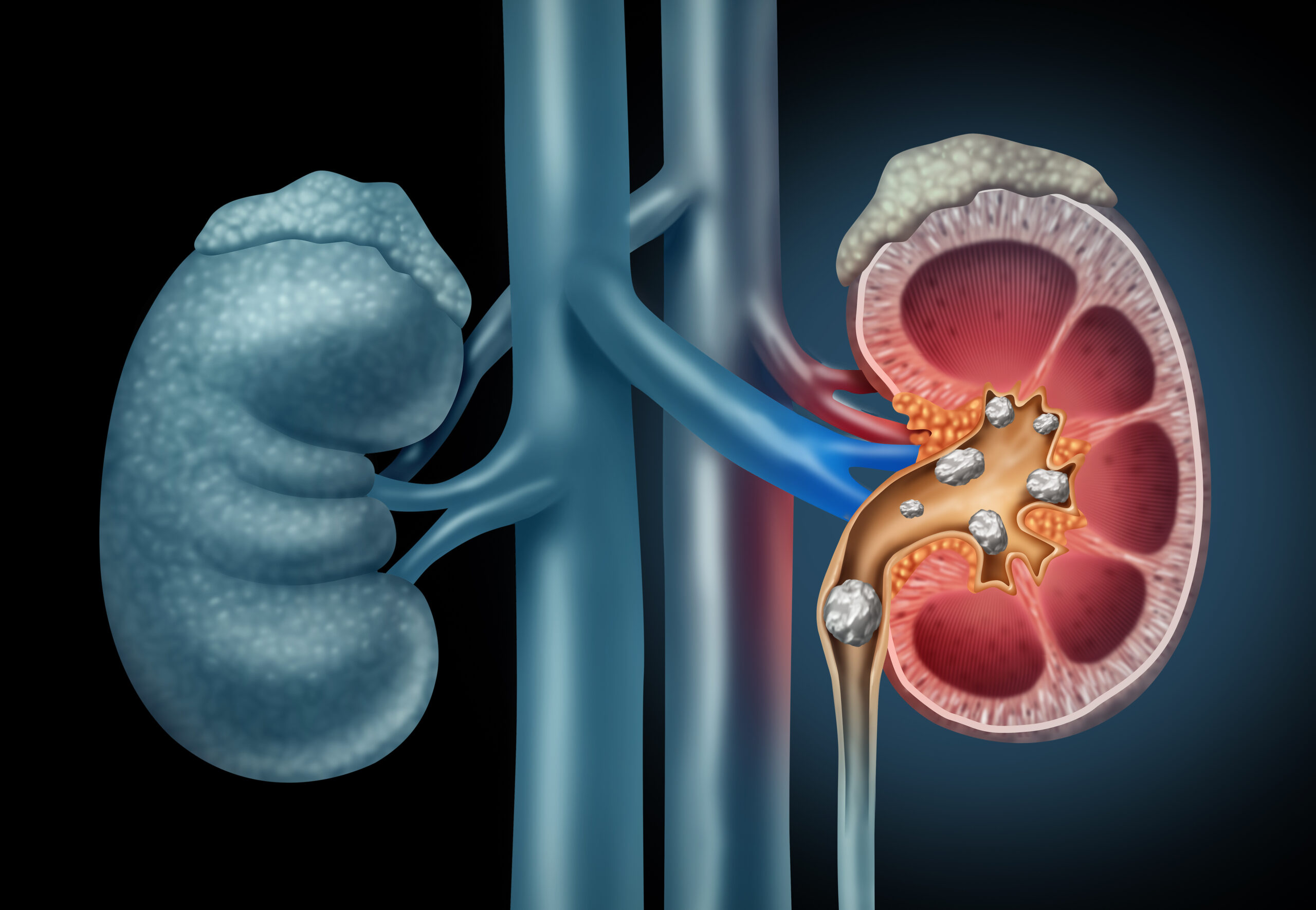 Urétéroscopie pour calculs au Cabinet d’urologie à Strasbourg