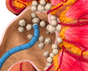 Lithiase urinaire au Cabinet d’urologie à Strasbourg