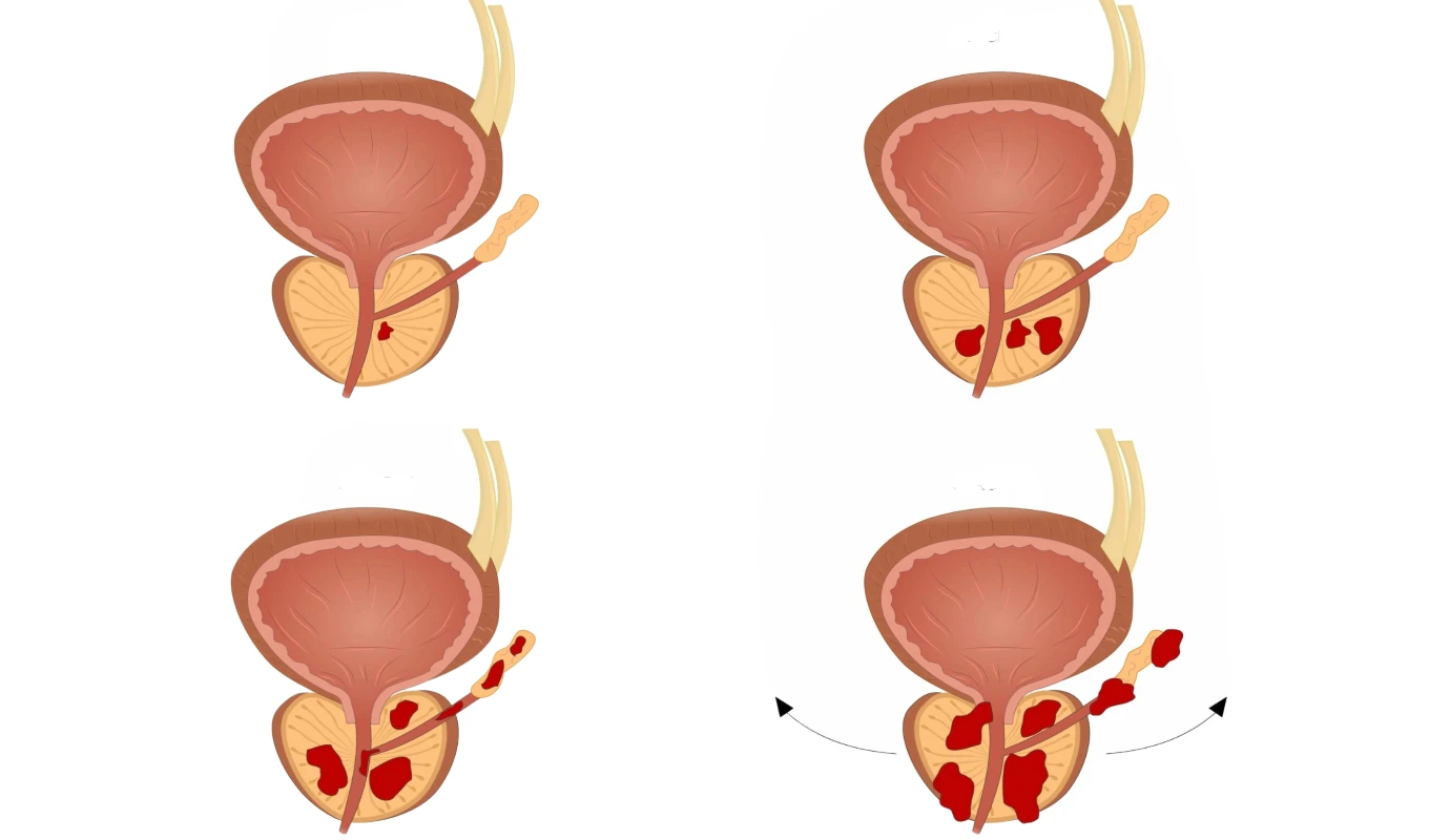 Cancer de prostate