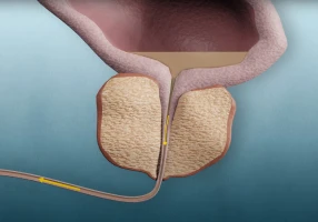 Élargissement bénin de la prostate au Cabinet d’urologie à Strasbourg